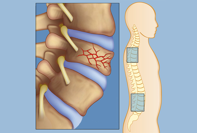 Compression Fracture » Hamilton Orthopaedics, Spine & Sports Medicine