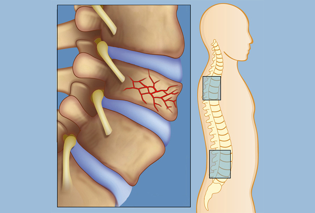 Cheltenham Spine Clinic - Osteoporotic Vertebral Compression Fractures