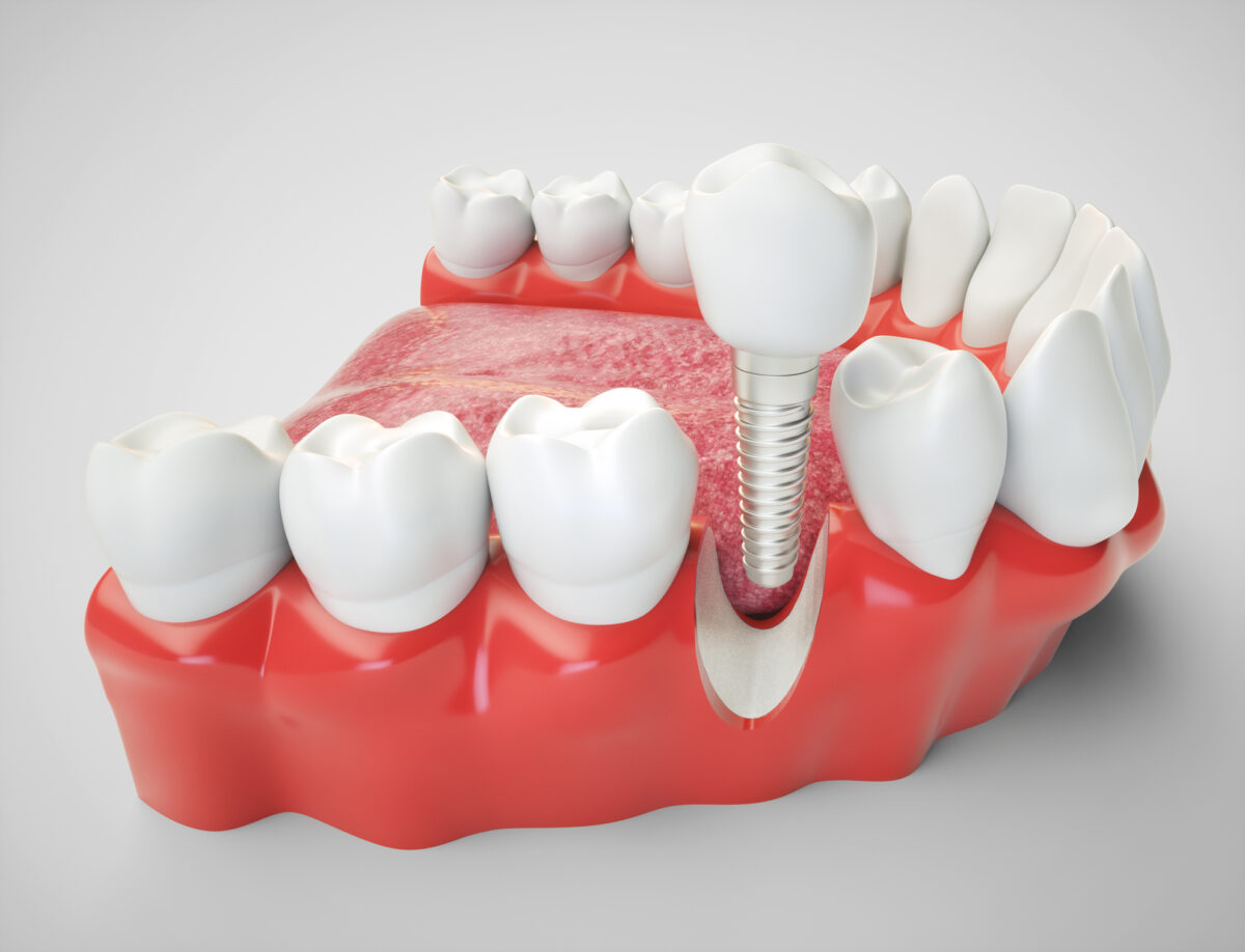 Scarsdale area dentist reorganizes dental implant businesses