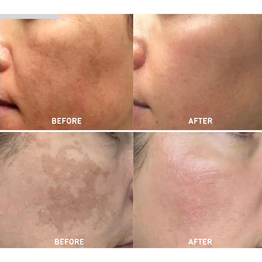 Melasma unmasked: strategies for diagnosis, prevention and treatment 