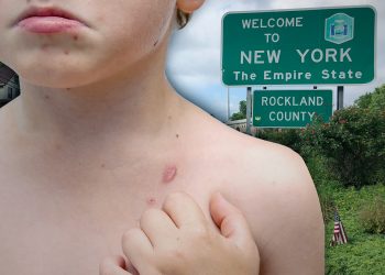 Measles case reported in Rockland