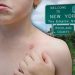 Measles case reported in Rockland