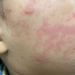 Measles case reported in Rockland