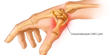 Middlesex Orthopedic & Spine Associates complete first in New England procedure